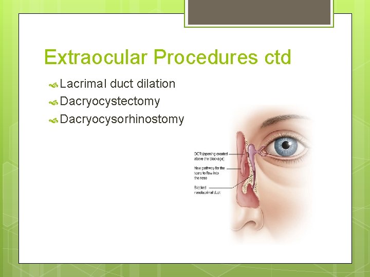 Extraocular Procedures ctd Lacrimal duct dilation Dacryocystectomy Dacryocysorhinostomy 