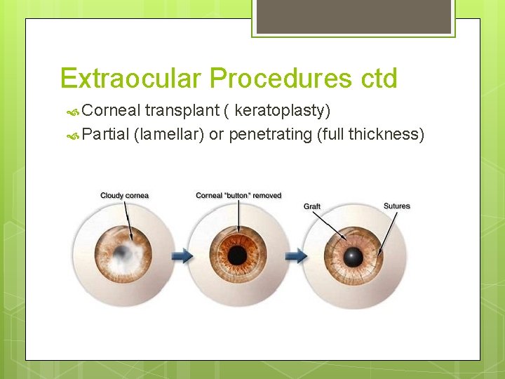 Extraocular Procedures ctd Corneal transplant ( keratoplasty) Partial (lamellar) or penetrating (full thickness) 