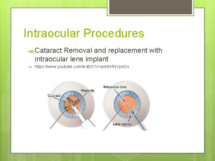 Intraocular Procedures Cataract Removal and replacement with intraocular lens implant https: //www. youtube. com/watch?