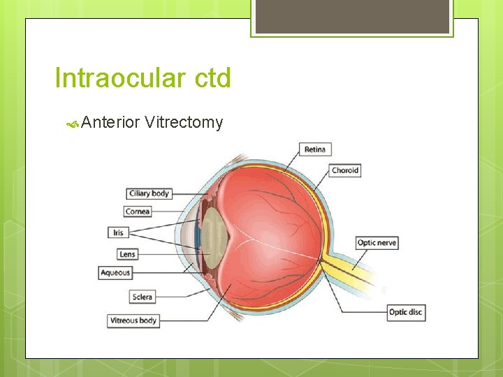Intraocular ctd Anterior Vitrectomy 