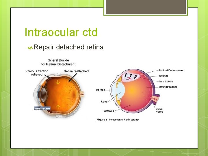 Intraocular ctd Repair detached retina 