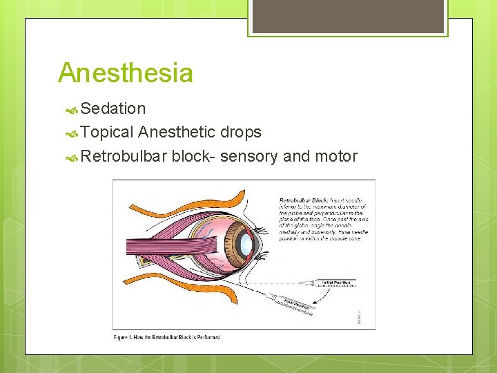 Anesthesia Sedation Topical Anesthetic drops Retrobulbar block- sensory and motor 
