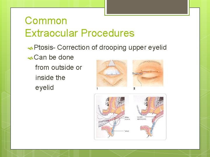 Common Extraocular Procedures Ptosis- Correction of drooping upper eyelid Can be done from outside