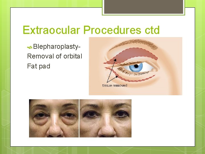Extraocular Procedures ctd Blepharoplasty- Removal of orbital Fat pad 