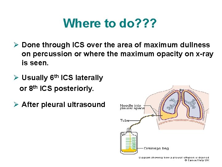 Where to do? ? ? Ø Done through ICS over the area of maximum Where to do? ? ? Ø Done through ICS over the area of maximum
