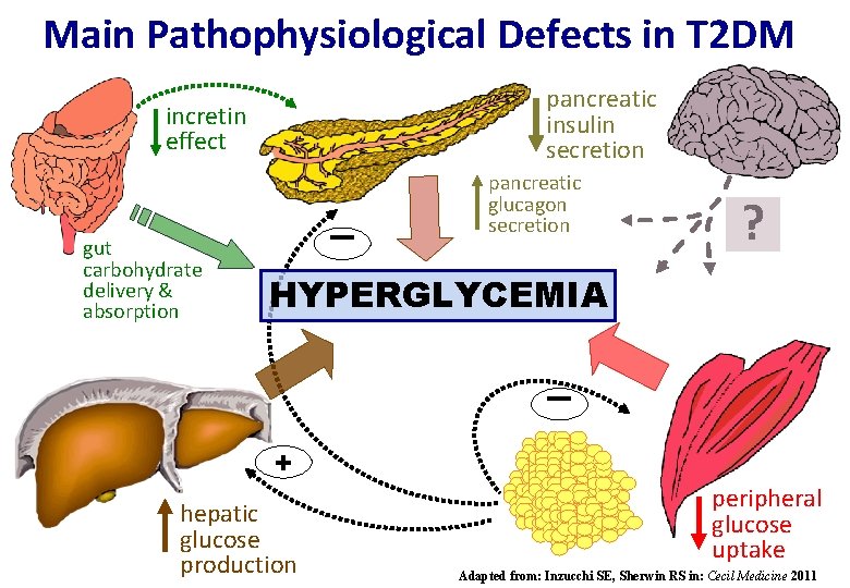 Main Pathophysiological Defects in T 2 DM pancreatic insulin secretion incretin effect - gut
