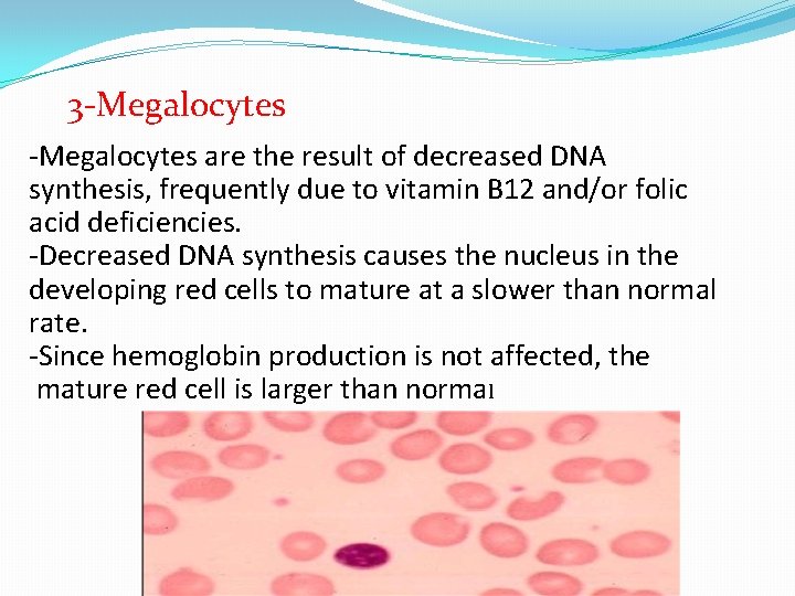 3 -Megalocytes are the result of decreased DNA synthesis, frequently due to vitamin B