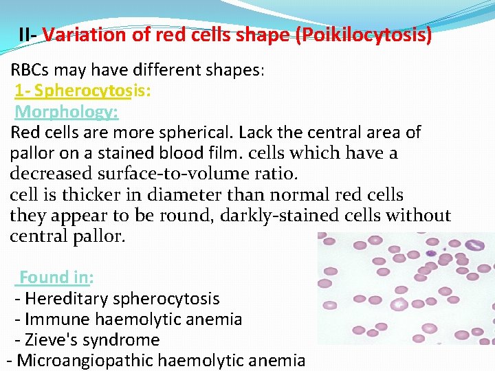 II- Variation of red cells shape (Poikilocytosis) RBCs may have different shapes: 1 -