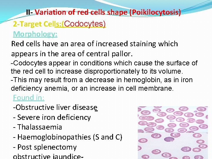 II- Variation of red cells shape (Poikilocytosis) 2 -Target Cells: (Codocytes) Morphology: Red cells