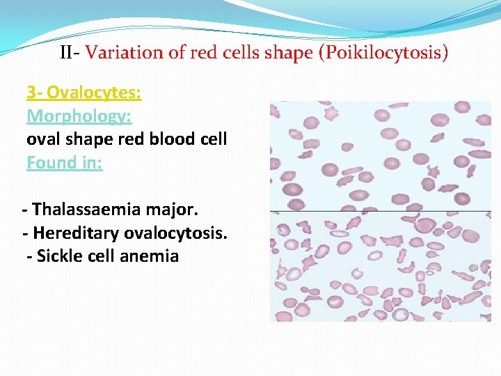 II- Variation of red cells shape (Poikilocytosis) 3 - Ovalocytes: Morphology: oval shape red