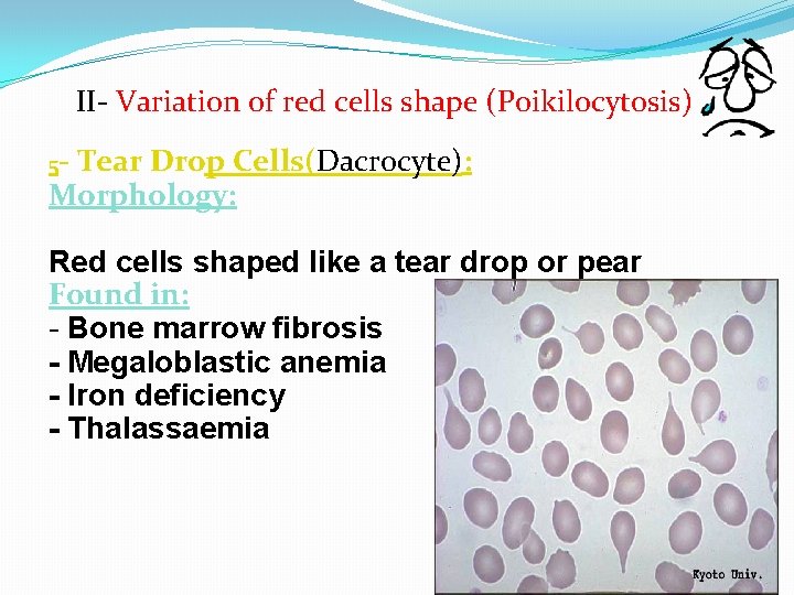 II- Variation of red cells shape (Poikilocytosis) 5 - Tear Drop Cells(Dacrocyte): Morphology: Red