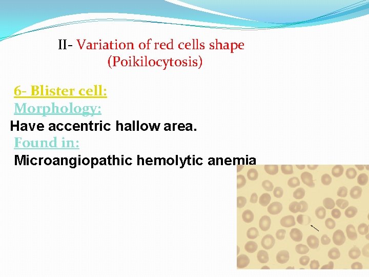 II- Variation of red cells shape (Poikilocytosis) 6 - Blister cell: Morphology: Have accentric