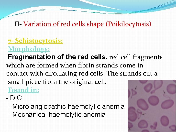 II- Variation of red cells shape (Poikilocytosis) 7 - Schistocytosis: Morphology: Fragmentation of the