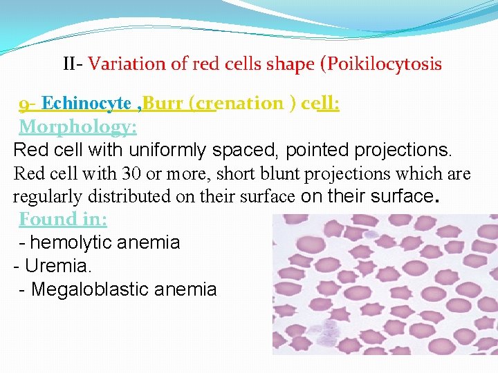 II- Variation of red cells shape (Poikilocytosis 9 - Echinocyte , Burr (crenation )