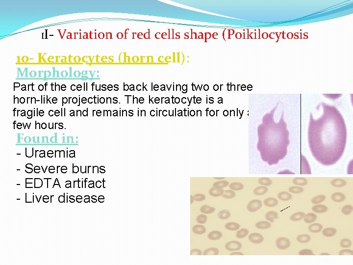 II- Variation of red cells shape (Poikilocytosis 10 - Keratocytes (horn cell): Morphology: Part