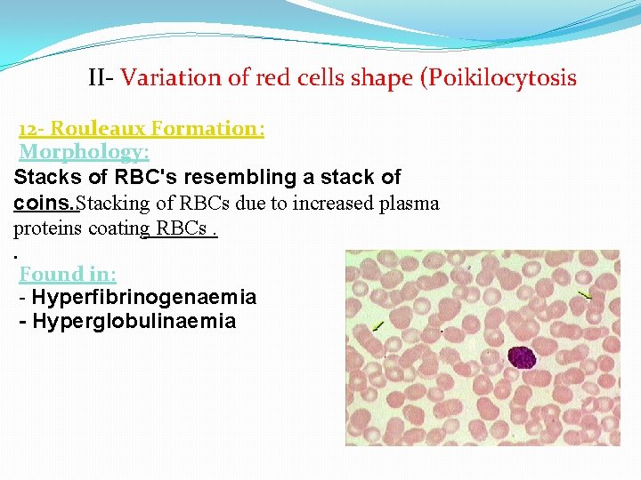 II- Variation of red cells shape (Poikilocytosis 12 - Rouleaux Formation: Morphology: Stacks of