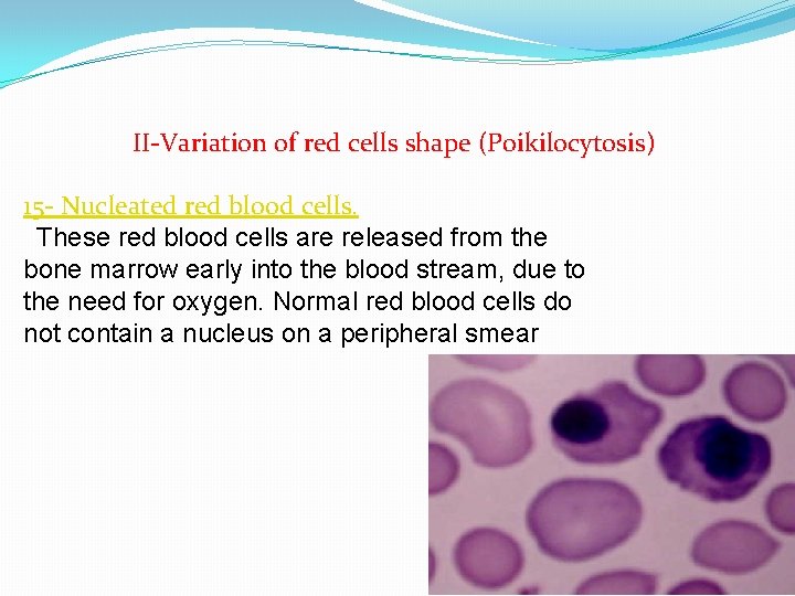 II-Variation of red cells shape (Poikilocytosis) 15 - Nucleated red blood cells. These red