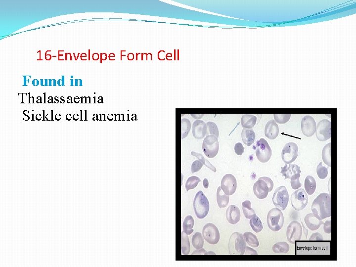 16 -Envelope Form Cell Found in Thalassaemia Sickle cell anemia 