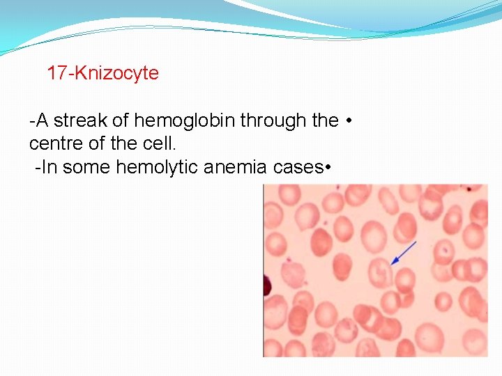 17 -Knizocyte -A streak of hemoglobin through the • centre of the cell. -In