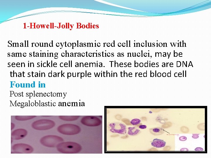 1 -Howell-Jolly Bodies Small round cytoplasmic red cell inclusion with same staining characteristics as