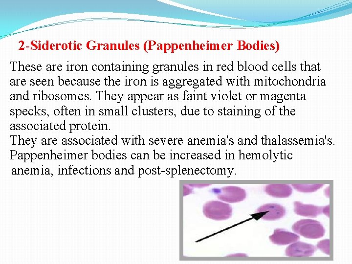2 -Siderotic Granules (Pappenheimer Bodies) These are iron containing granules in red blood cells