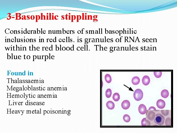 3 -Basophilic stippling Considerable numbers of small basophilic inclusions in red cells. is granules