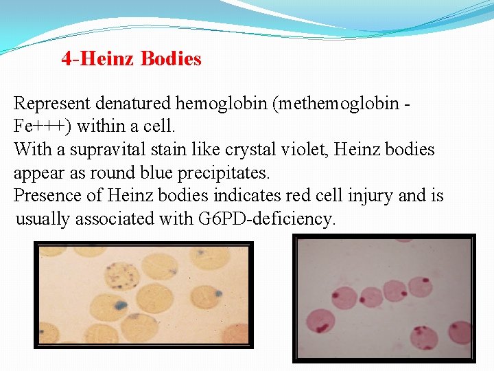 4 -Heinz Bodies Represent denatured hemoglobin (methemoglobin Fe+++) within a cell. With a supravital