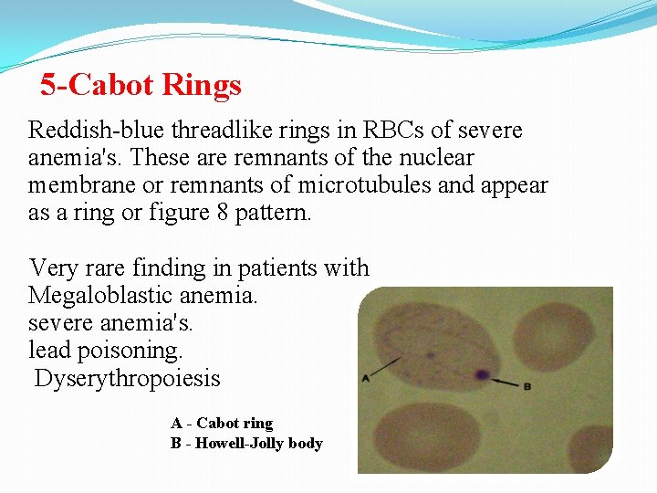 5 -Cabot Rings Reddish-blue threadlike rings in RBCs of severe anemia's. These are remnants