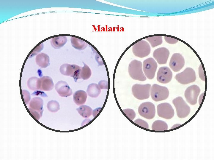 Malaria 