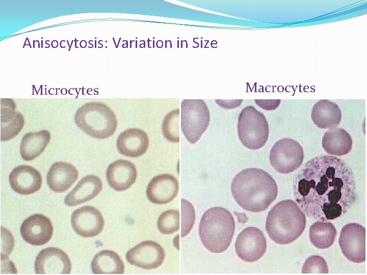 Anisocytosis: Variation in Size Microcytes Macrocytes 