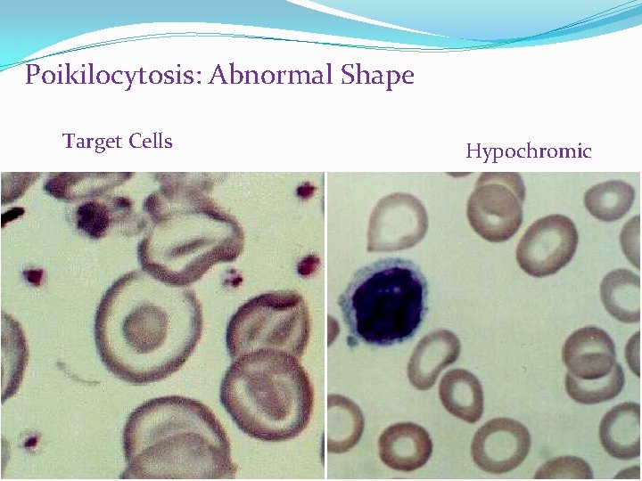 Poikilocytosis: Abnormal Shape Target Cells Hypochromic 