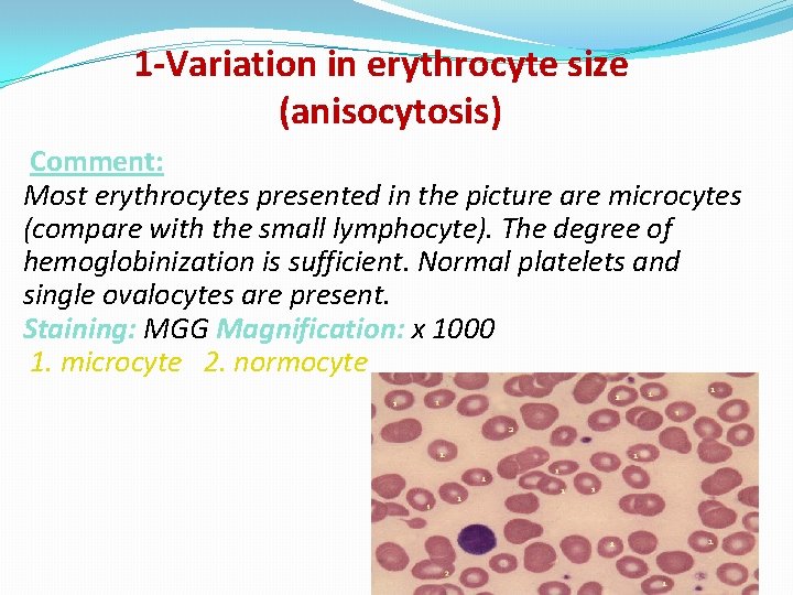 1 -Variation in erythrocyte size (anisocytosis) Comment: Most erythrocytes presented in the picture are