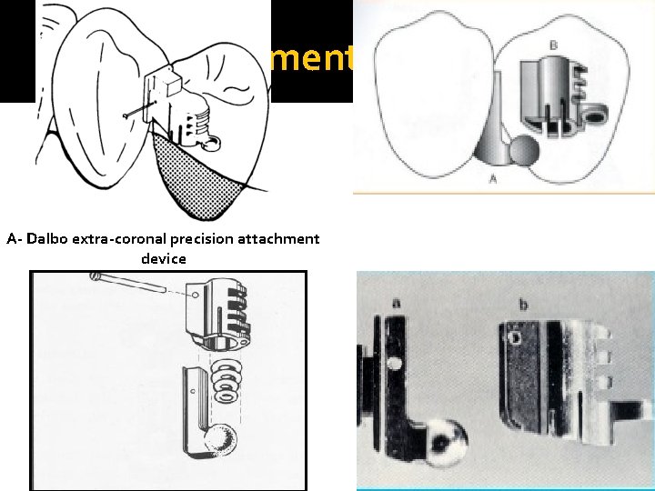 Dalbo attachment A- Dalbo extra-coronal precision attachment device 