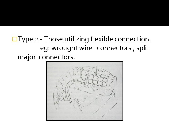 �Type 2 - Those utilizing flexible connection. eg: wrought wire connectors , split major