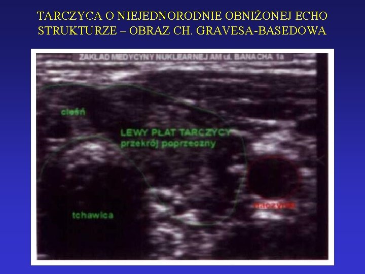 TARCZYCA O NIEJEDNORODNIE OBNIŻONEJ ECHO STRUKTURZE – OBRAZ CH. GRAVESA-BASEDOWA 