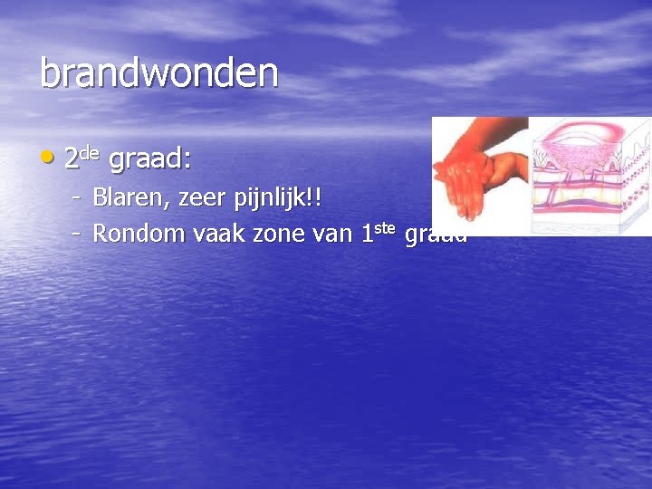 brandwonden • 2 de graad: - Blaren, zeer pijnlijk!! - Rondom vaak zone van