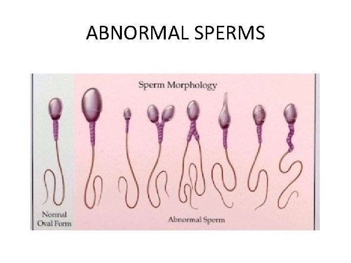 ABNORMAL SPERMS 