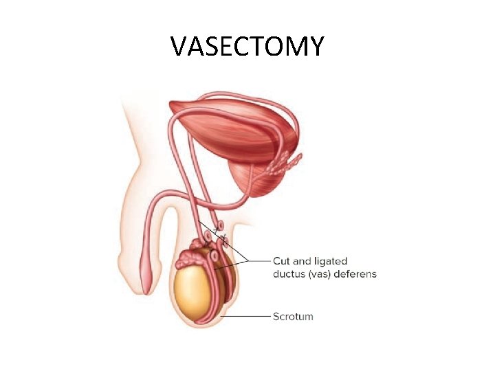 VASECTOMY 