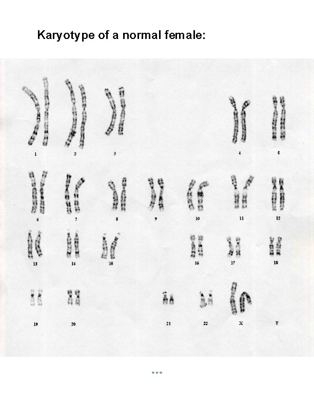 Karyotype of a normal female: 