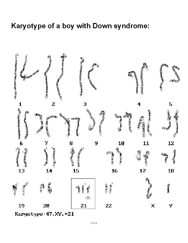 Karyotype of a boy with Down syndrome: 