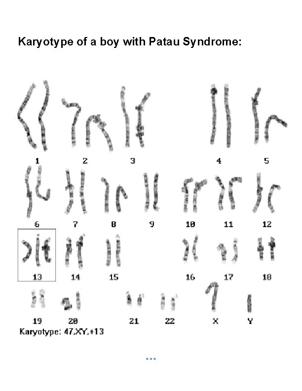 Karyotype of a boy with Patau Syndrome: 