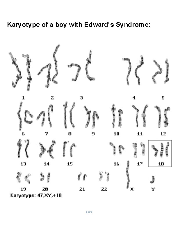 Karyotype of a boy with Edward’s Syndrome: 