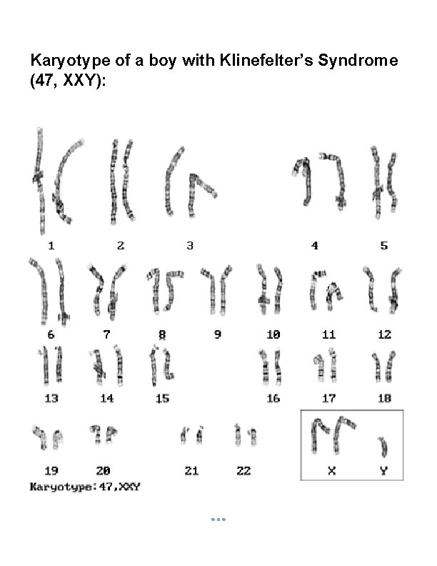 Karyotype of a boy with Klinefelter’s Syndrome (47, XXY): 