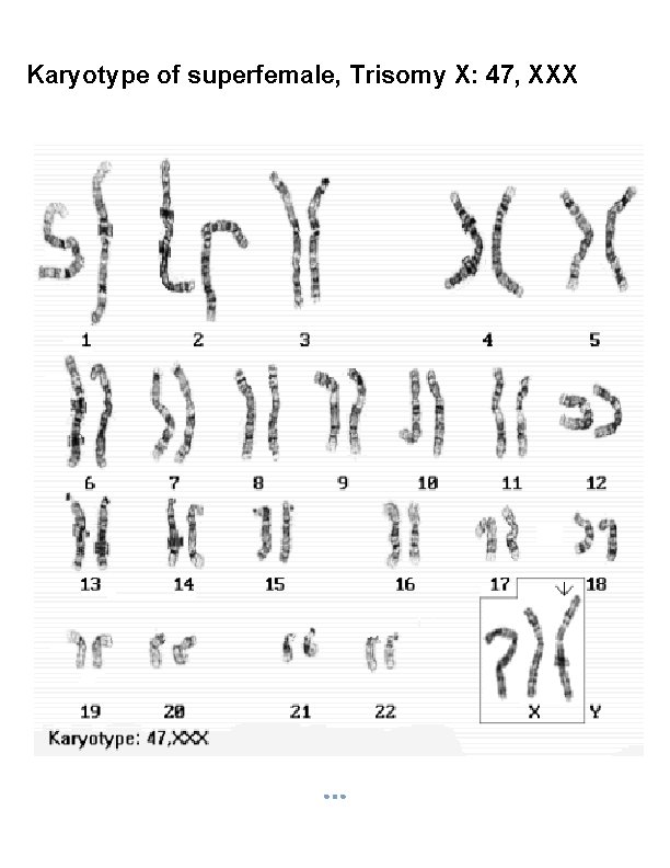 Karyotype of superfemale, Trisomy X: 47, XXX 