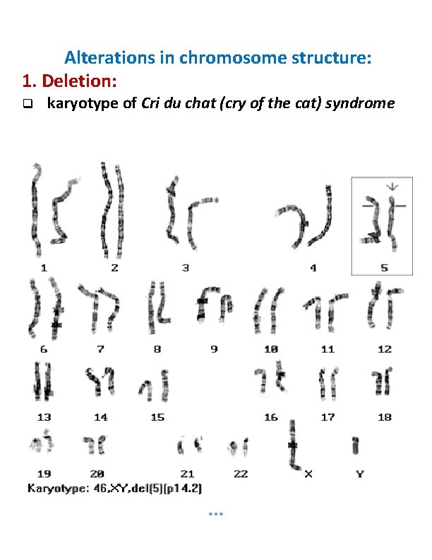 Alterations in chromosome structure: 1. Deletion: karyotype of Cri du chat (cry of the