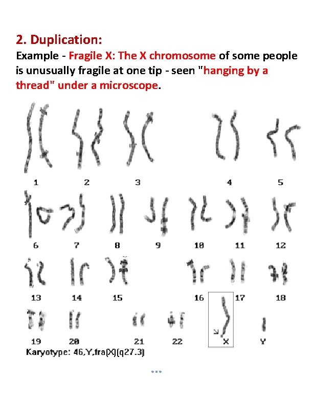 2. Duplication: Example - Fragile X: The X chromosome of some people is unusually