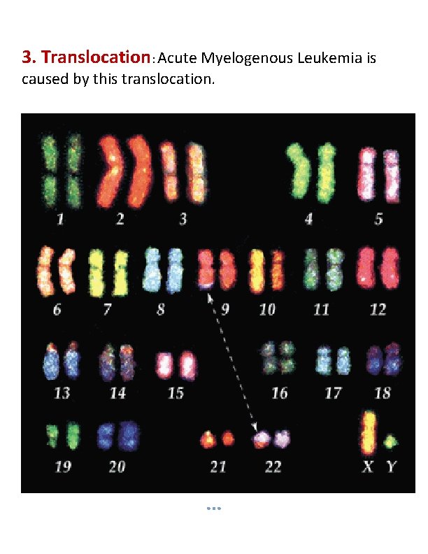 3. Translocation: Acute Myelogenous Leukemia is caused by this translocation. 