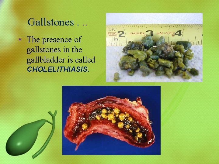  Gallstones. . . • The presence of gallstones in the gallbladder is called