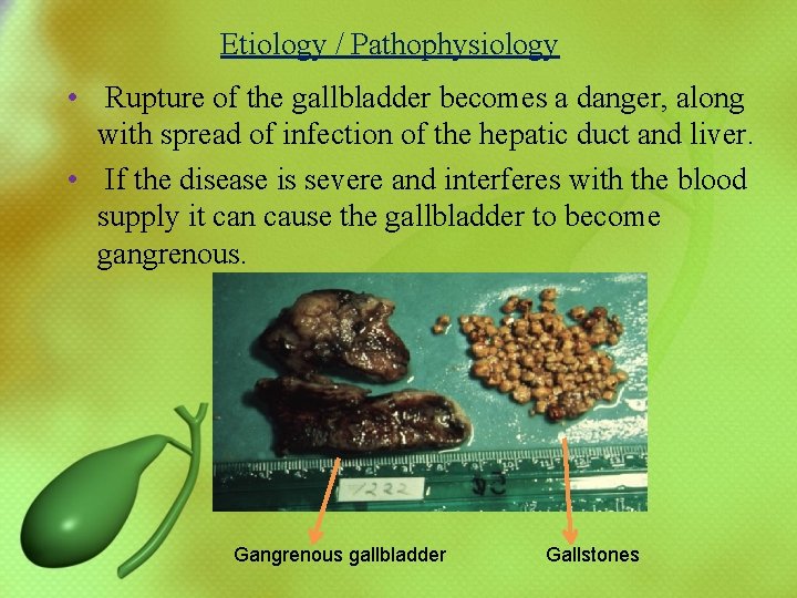 Etiology / Pathophysiology • Rupture of the gallbladder becomes a danger, along with spread