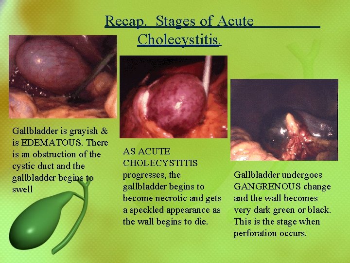 Recap. Stages of Acute Cholecystitis. Gallbladder is grayish & is EDEMATOUS. There is an